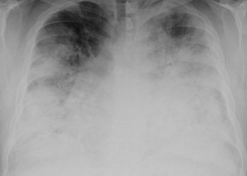 Alertă sanitară: 12 cazuri de boală legionară, inclusiv un deces