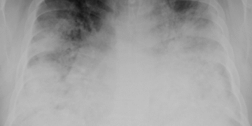 Alertă sanitară: 12 cazuri de boală legionară, inclusiv un deces