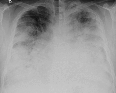 Alertă sanitară: 12 cazuri de boală legionară, inclusiv un deces