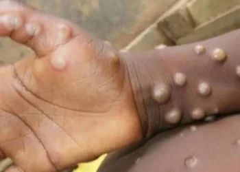 Etiopia raportează primul deces cauzat de variola maimuței