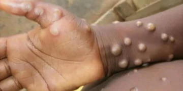 Etiopia raportează primul deces cauzat de variola maimuței