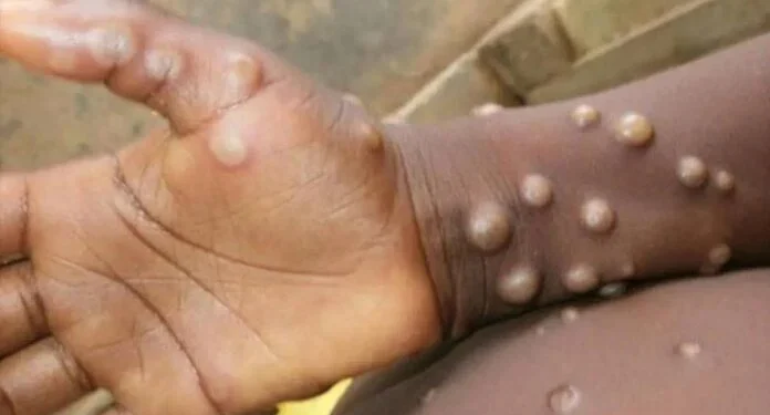 Etiopia raportează primul deces cauzat de variola maimuței