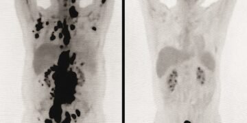 Un tratament care ar putea opri creșterea celulelor canceroase